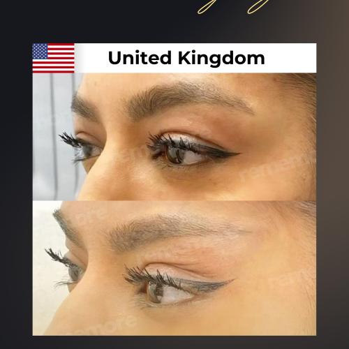 رأب الجفن صور ماقبل / ما بعد